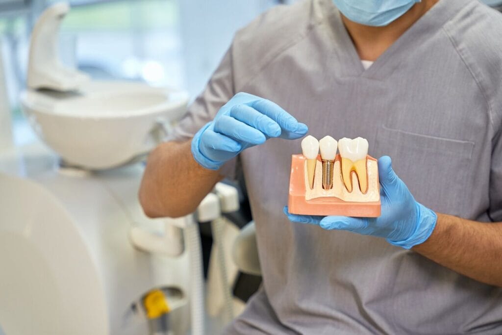 Impianti dentali, prima e dopo: tutto quello che devi sapere 6 Impianti dentali prima e dopo tutto quello che devi sapere