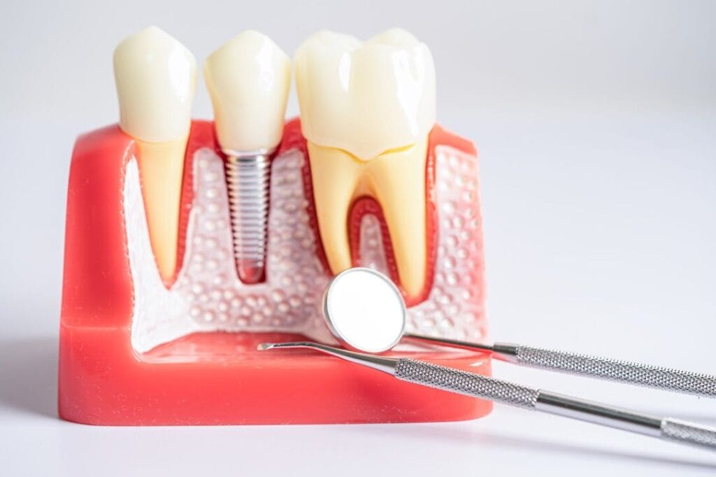 Soluzione per i denti mancanti: quanto sono sicuri gli impianti dentali? 9 Soluzione per i denti mancanti quanto sono sicuri gli impianti dentali