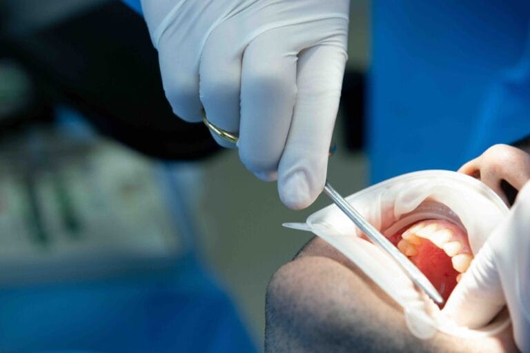 News 1 Quando togliere i denti del giudizio