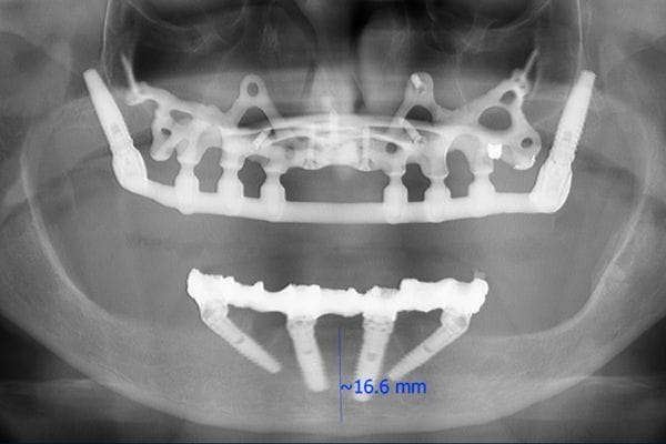 Cosa Sono gli Impianti iuxtaossei e Quali Benefici 3 impianto dentale poco osso eagle grid